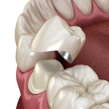 Răng Sứ Kim Loại